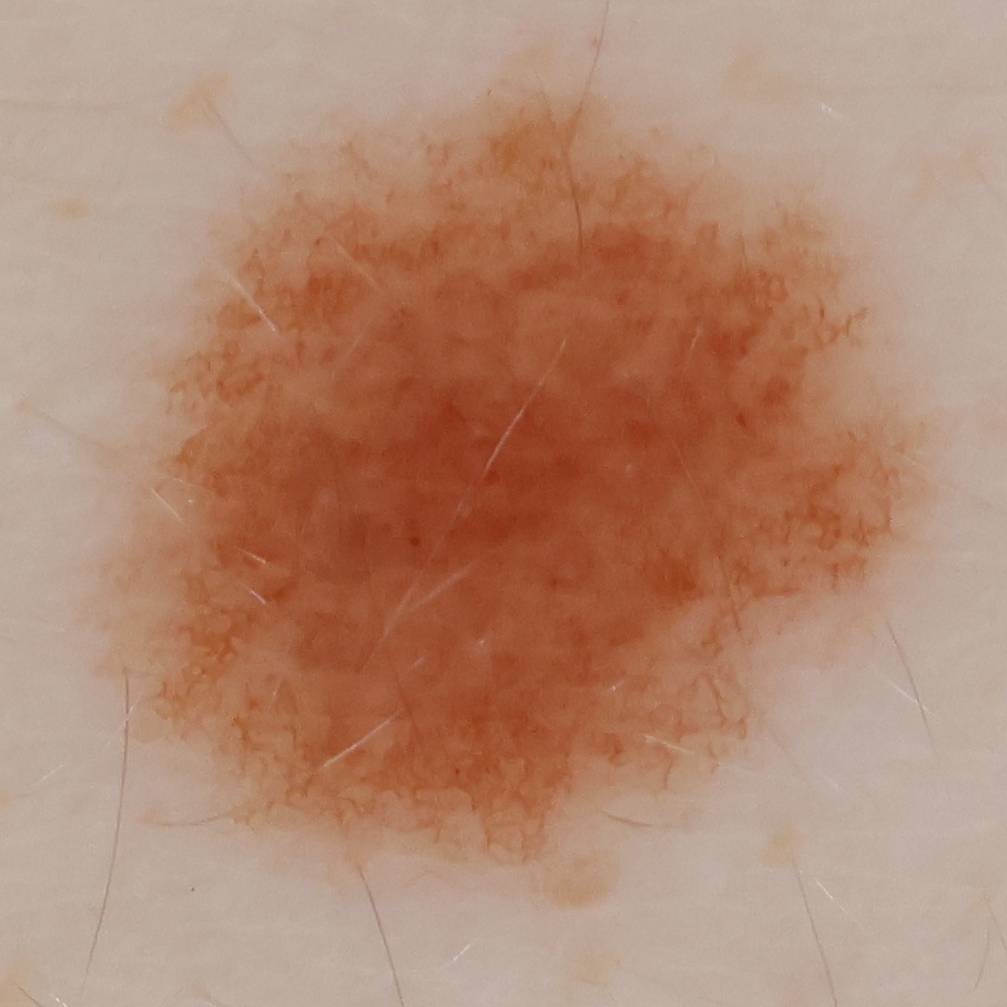 High-resolution crop of a 6.4-millimeter mole captured during an OpenDerm scan.