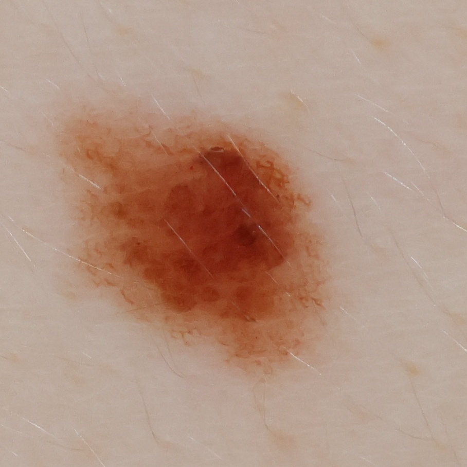 High-resolution crop of a 3.8-millimeter mole captured during an OpenDerm scan.