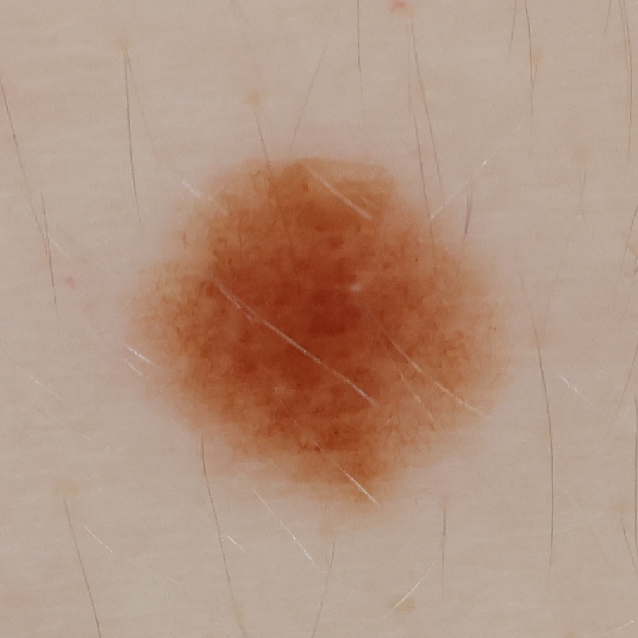 High-resolution crop of a 4.1-millimeter mole captured during an OpenDerm scan.